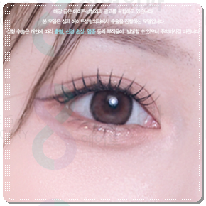 Ptosis Correction Cost: What Are the Criteria for Choosing Non-Incisional or Incisional Surgery? image 5