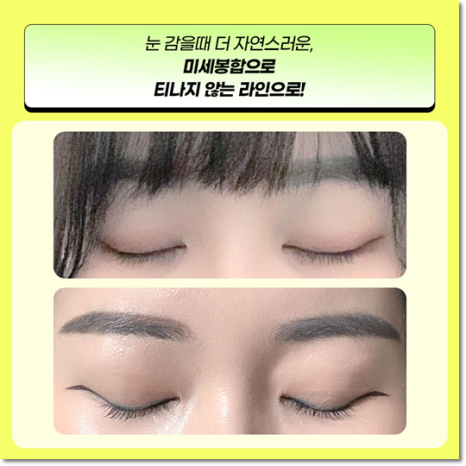 쌍수 가격은 평균적으로 얼마일까요? 매몰과 비절개? 절개 차이점까지 관련 이미지 7