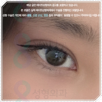 내 눈에 맞는 앞트임 필요할까? 수술 방법과 대략적인 비용 안내 관련 이미지 3