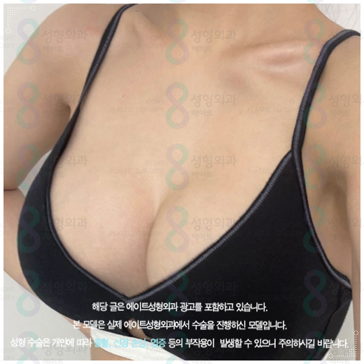 처진가슴 리프팅 수술, 출산후 수유후, 가슴 올리기, 보형물로 가능한가요? 관련 이미지 3