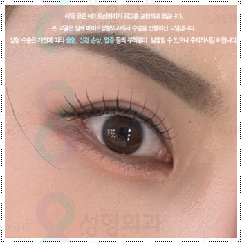 눈 앞트임과 윗트임 준비, 내돈내산 후기를 찾아볼 때 수술 전후 확인할 것 (비용 등) 관련 이미지 2