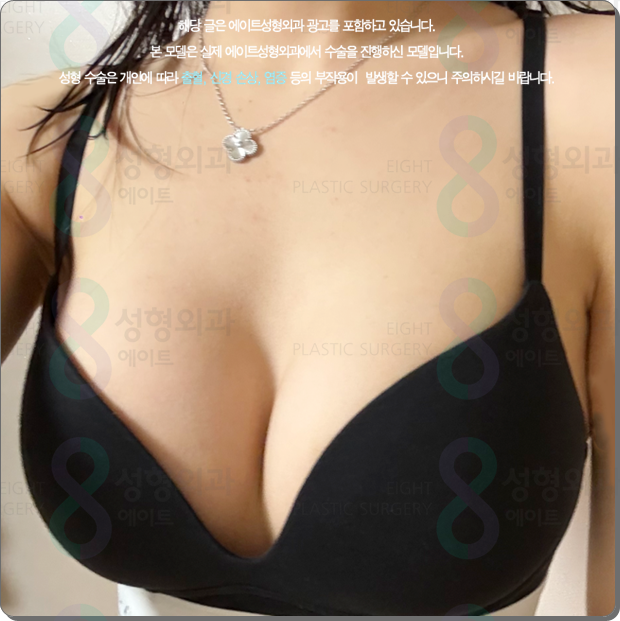 압구정역 가슴수술, 성형외과 추천? 멘토 엑스트라는 비용 전에 가슴 트레이닝센터, 의사를 확인 관련 이미지 1