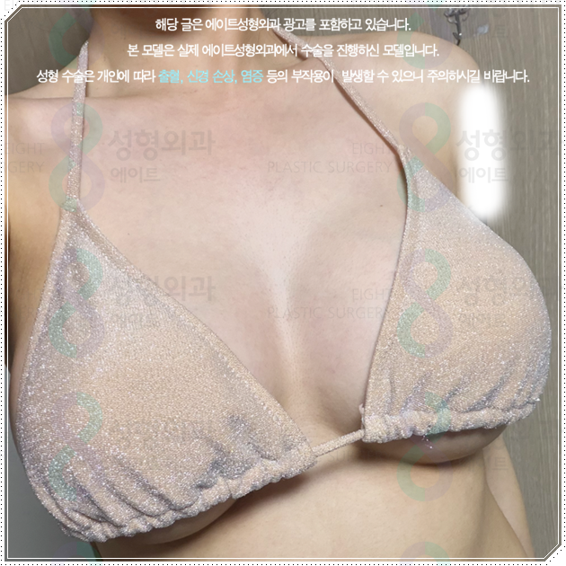 Why Do Breast Augmentation Surgery Prices Differ by Type, and How Can You Avoid Side Effects? image 3