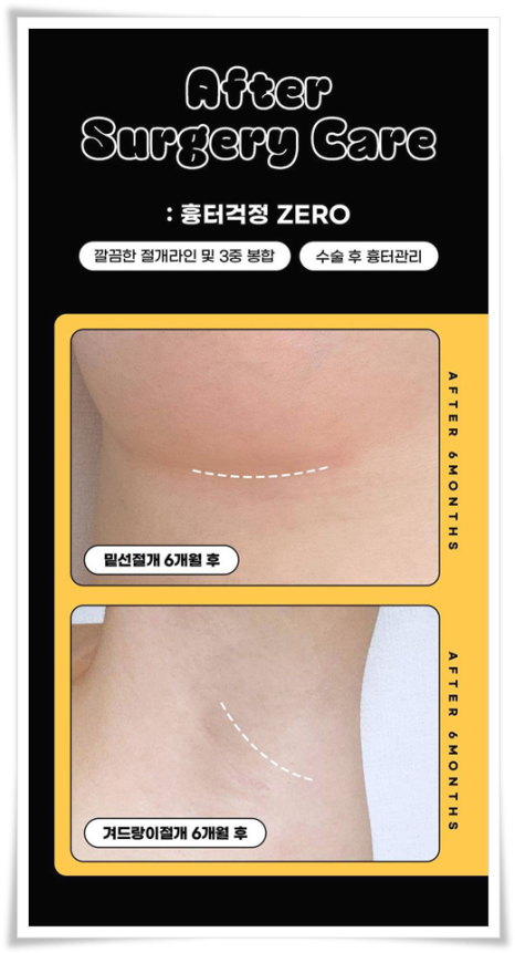 멘토 엑스트라 모티바 차이, 비용, 가슴보형물 종류 고르는법 관련 이미지 7
