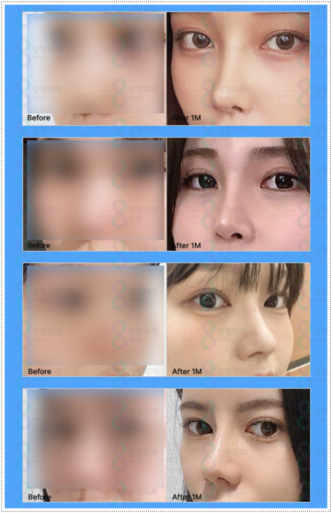 코수술 후기 일주일 1개월 비교? 평균 비용, 코성형 종류 장단점은? 관련 이미지 8