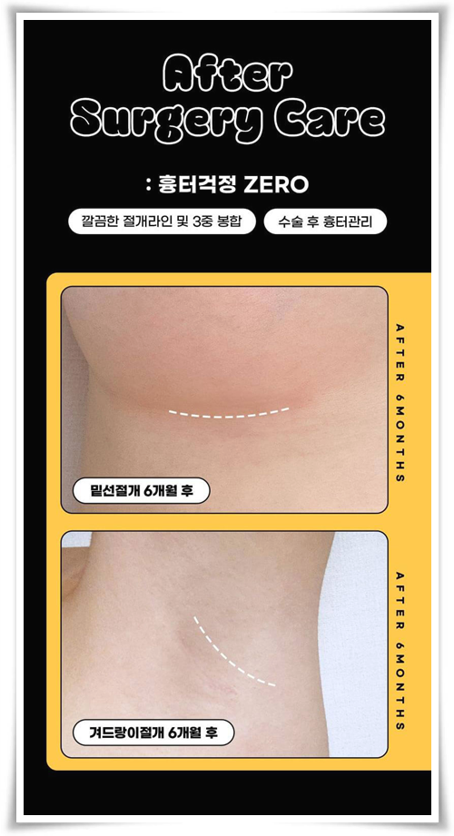 Motiva Breast Augmentation Review and Cost (Price) Comparison image 15