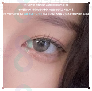 연예인 쌍꺼풀 종류? 평균 쌍커풀 수술비용 차이는 왜 나나요? 관련 이미지 5