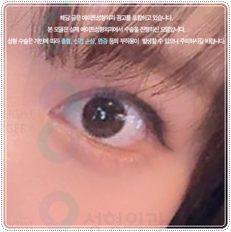 Preparing for the Cost and Swelling When Combining Medial and Lateral Canthoplasty with Double-Eyelid Surgery: A Comparison image 2