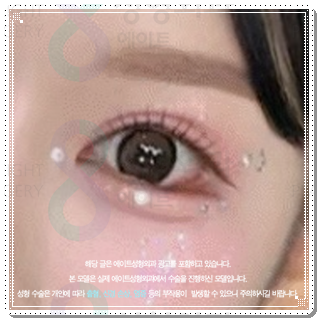 보통 자연유착과 밑트임을 같이하면 붓기는 언제 빠질까요? 관련 이미지 6