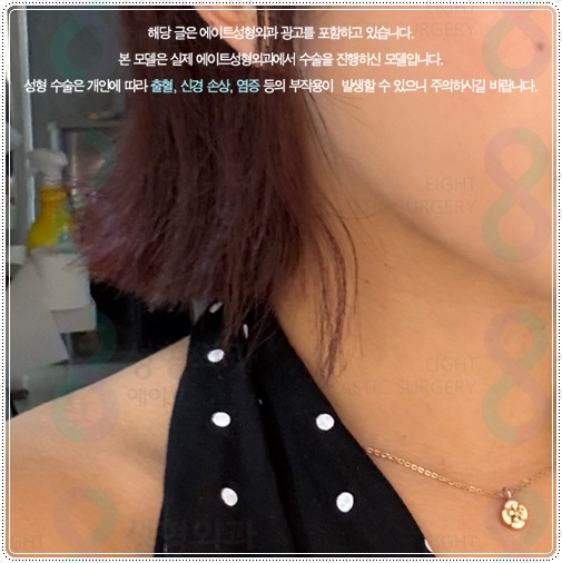 The Difference Between 300 and 600 Lines of Ultherapy: What to Check Before Comparing Lifting Costs image 3