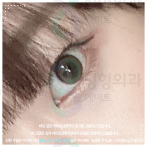속쌍꺼풀 수술 티안나려면 인라인으로 해야할까? 관련 이미지 1