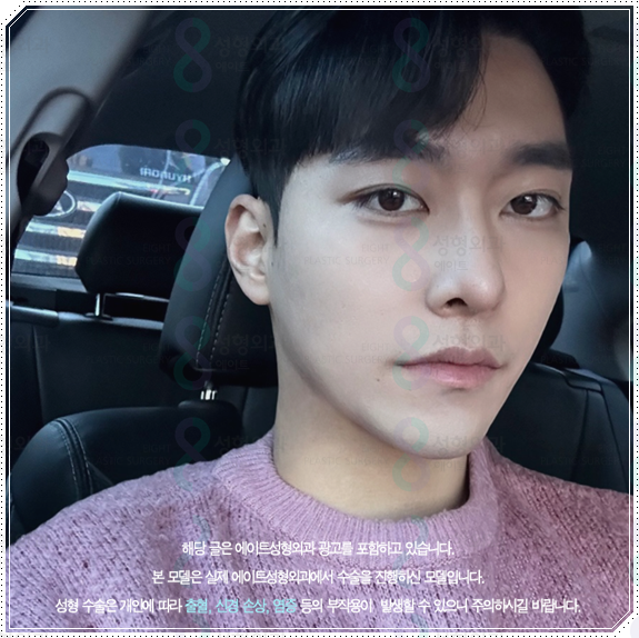 남자 코성형 종류 어떤 게 맞을까? 평균 비용부터 회복기간, 발품 팁까지 완벽 가이드 관련 이미지 3