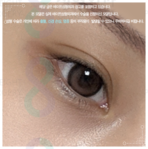 When Can You Wear Makeup After Non-Incisional Double Eyelid Surgery? Including Reviews of Swelling and Loss of the Fold image 1