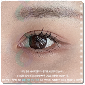 Why Choose Partial Incision Instead of Non-Incision Double-Eyelid Surgery? Meaning, Cost, and When Does the Swelling Go Down? image 3