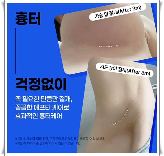 가슴확대수술비용 차이는 왜 나나요? 관련 이미지 7