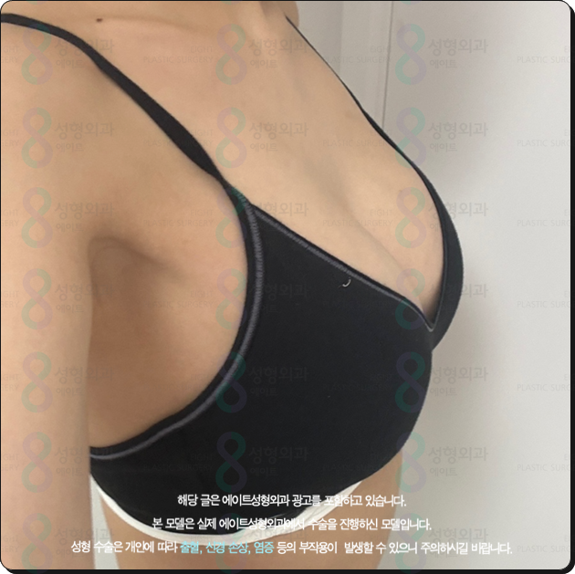 Breast Augmentation Surgery Cost (Price) and the Secret to a Review with No Side Effects Before and After? image 6