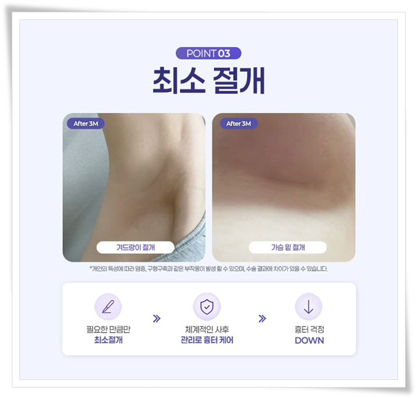 가슴성형 시 사용되는 보형물 종류와 가격 차이는 왜 생기나요? 관련 이미지 13