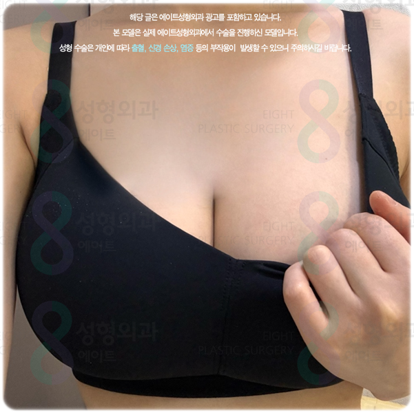 가슴확대수술, 후기와 비용·붓기·회복 기간은 어떻게 될까? 관련 이미지 5