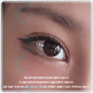 Suture or Incision? Which Double-Eyelid Design Looks Best? Understanding the Differences Between In-Out and In-Line Creases, Including the Semi-Out Line image 4