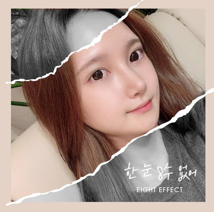 코성형가격 매부리코 코끝성형 짧은코 짧은코재수술 관련 이미지 6