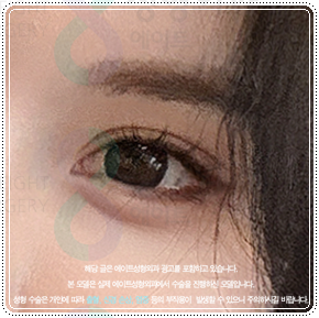 첫 쌍꺼풀 수술을 절개로 하고 눈 재수술은 매몰법(자연유착)으로 못하나? 비용 붓기는? 관련 이미지 1