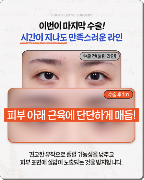 실패 없는 쌍꺼풀 재수술을 위해: 매몰법 특징부터 비용, 시기별 붓기 회복 과정 관련 이미지 10