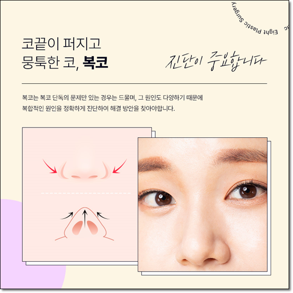 남자와 여자 차이? 매부리코는 수술 가격이 다를까요? 관련 이미지 9