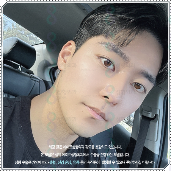 남자 코성형 종류 어떤 게 맞을까? 평균 비용부터 회복기간, 발품 팁까지 완벽 가이드 관련 이미지 6