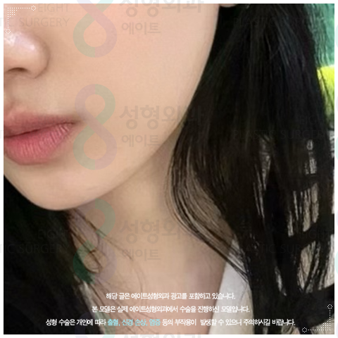 울쎄라 리프팅은 300샷으로 어느정도 효과가 있을까? 관련 이미지 4