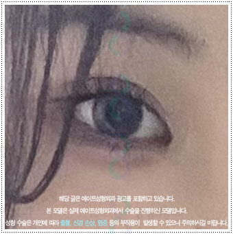 What Are the Prices and Combined Effects of Epicanthoplasty and Upper Epicanthoplasty with Double Eyelid Surgery? From Eye Shape Changes in Reviews of Front-and-Upper Epicanthoplasty to the Differences image 3