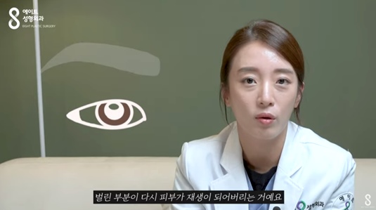 The Concept of Epicanthoplasty Revision and Reconstruction image 2