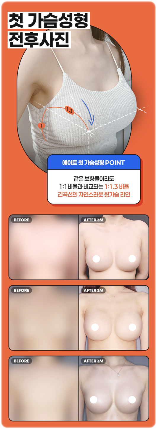 How to Increase Breast Size, Recovery Period for Breast Augmentation with High Satisfaction, Without Worrying About Pain image 10