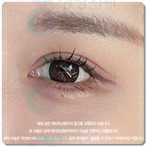 Why Choose Partial Incision Instead of Non-Incision Double-Eyelid Surgery? Meaning, Cost, and When Does the Swelling Go Down? image 4