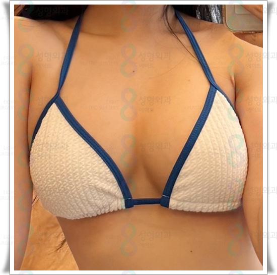가슴확대 수술 가격, 보형물 종류 차이가 있나요? 관련 이미지 6