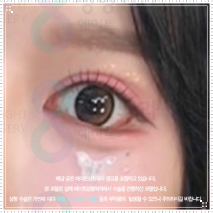 자연유착 쌍꺼풀 수술 후기 | 압구정 쌍수 밑트임 후 붓기 한달 변화 참고 후기 관련 이미지 3