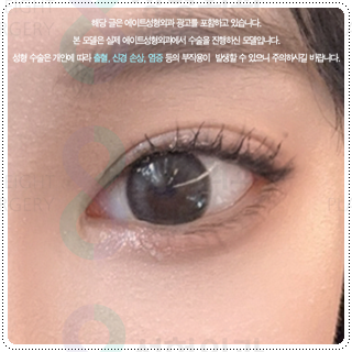 Natural Double Eyelid Surgery Using the Non-Incisional Method: A Budget and Consultation Guide for Middle School Students’ Eye Shapes Before and After Surgery image 1