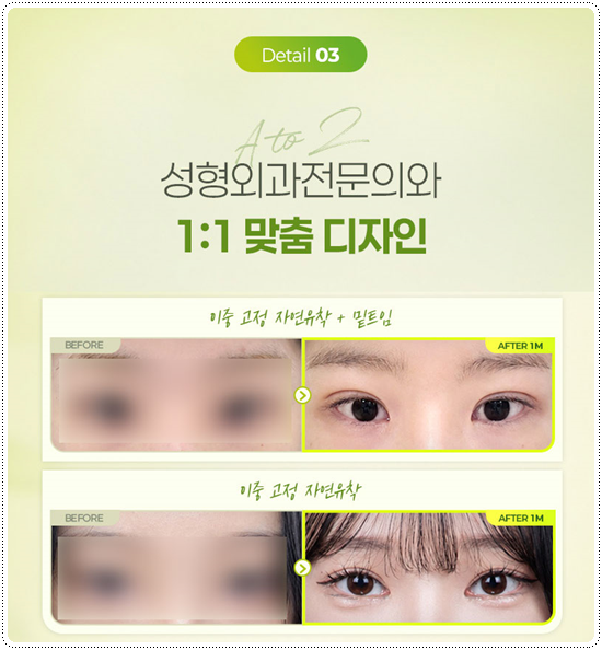 강남 쌍커플 알아볼 때, 가격보다 먼저 확인해야 할 것 관련 이미지 10