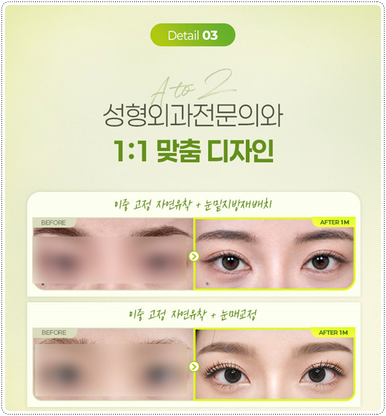 강남 쌍커플 알아볼 때, 가격보다 먼저 확인해야 할 것 관련 이미지 9