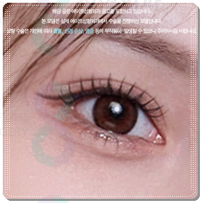 Ptosis Correction Cost: What Are the Criteria for Choosing Non-Incisional or Incisional Surgery? image 4