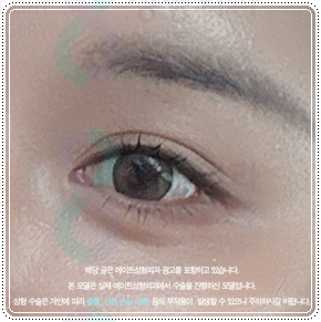 첫 쌍꺼풀 수술을 절개로 하고 눈 재수술은 매몰법(자연유착)으로 못하나? 비용 붓기는? 관련 이미지 4