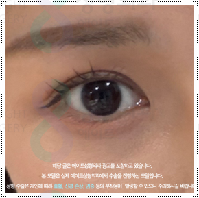 쌍커풀재수술 절개쌍수 말고 매몰은 못하나? 재수술 시 가격 얼마? 관련 이미지 5