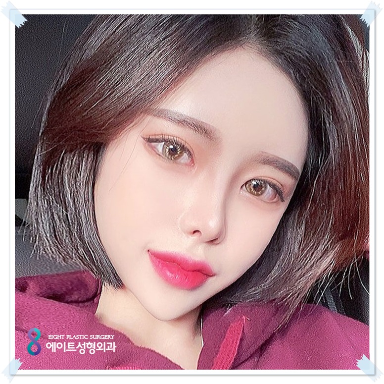 Which Eyes Need a Difference Before and After Epicanthoplasty? image 1