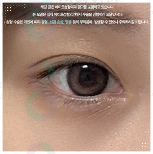 When Can You Wear Makeup After Non-Incisional Double Eyelid Surgery? Including Reviews of Swelling and Loss of the Fold image 4