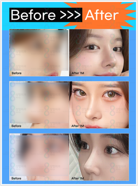 코수술 후기 일주일 1개월 비교? 평균 비용, 코성형 종류 장단점은? 관련 이미지 7