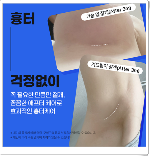What Is the Average Cost (Price) of Breast Augmentation Surgery? image 8