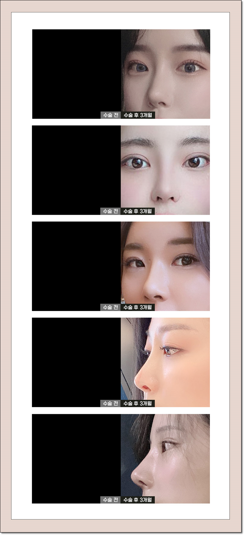Why Facial Proportions Matter for a Straight-But-Slightly-Upturned Nose image 2