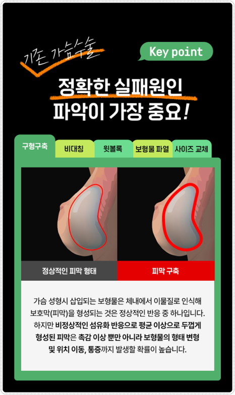 가슴 재수술 흉터, 통증 걱정이 될 때, 알맞은 시기와 생생한 후기 찾아보기 관련 이미지 10