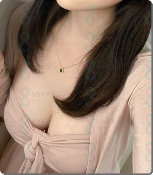 가슴성형 보형물 종류, 교체, 제거 시 모티바 보형물 재수술 알아보는 이유 관련 이미지 3