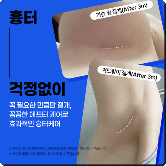 가슴확대수술비용 어떻게 비교하나요? 관련 이미지 15