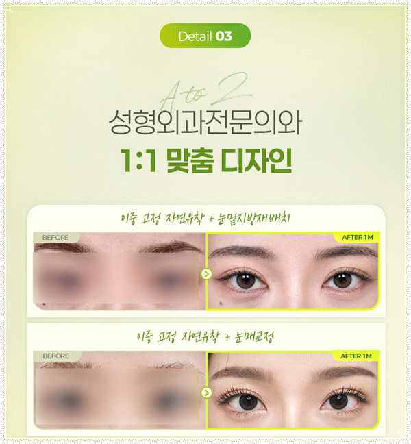 인라인 쌍꺼풀 후기, 쌍수 전과 1개월 후 라인은 어떻게 달라질까 관련 이미지 12